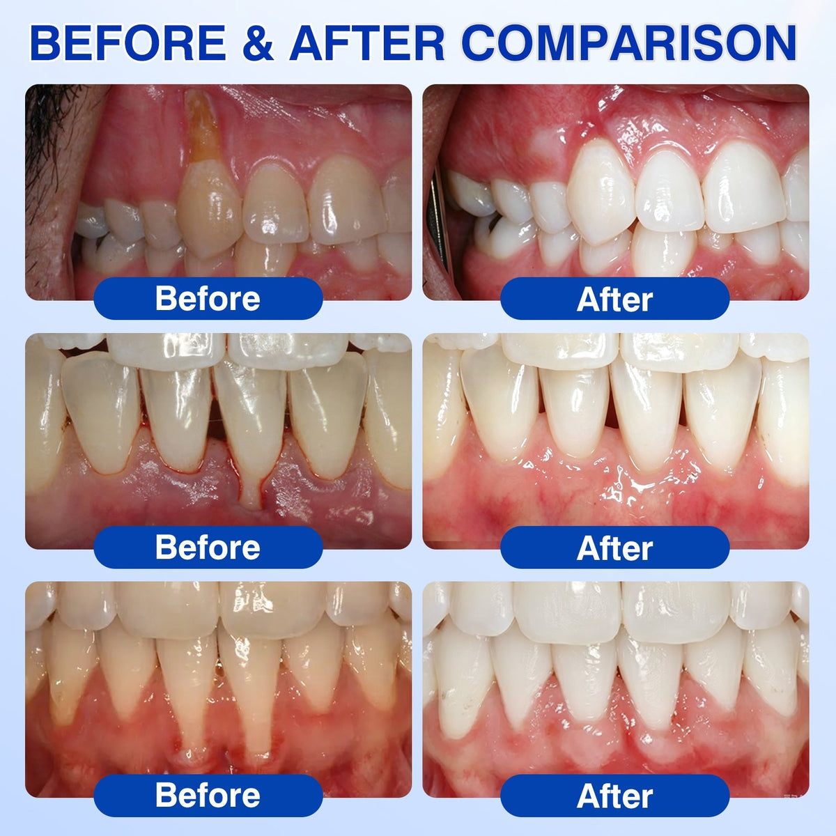 🇦🇺👨‍⚕️🦷🎯Evolvion® GumRevive Periodontal Repair Gel